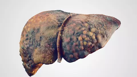Așa arată ficatul unui bolnav de carcinom hepatocelular. Cum poți depista la timp această boală