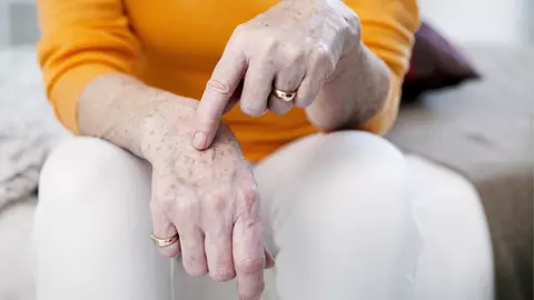 Tratamente naturale cu efecte spectaculoase care te scapă de petele de bătrânețe de pe piele