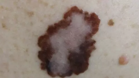 Așa arată cancerul de piele. O simplă aluniță poate fi semnul melanomului