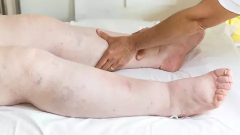 Cel mai simplu și eficient remediu pentru picioarele umflate! Face minuni pentru sănătate