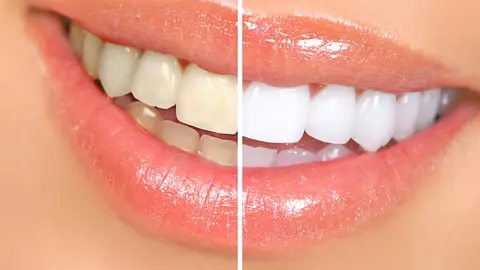 Se mai pot albi dintii dupa implantul dentar? Daca da, cum?