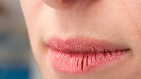 Remediul care te ajută să scapi rapid de buzele crăpate