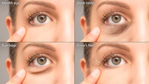 Cum să scapi de cearcăne și de petele întunecate de pe piele, peste noapte! Secretul sunt câteva ingrediente naturale