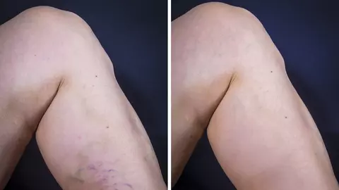 Cum să scapi de varice. Remediile naturale care te ajută