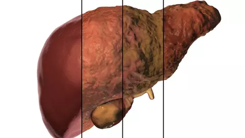 Ce este fibroza hepatică și care sunt cauzele care duc la apariția acestei boli?