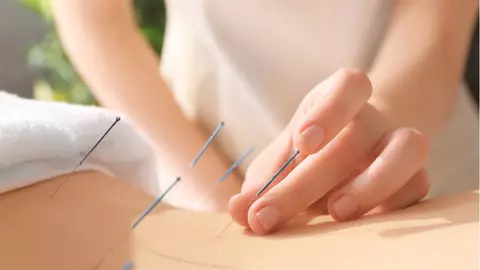Bolile pe care le poți trata cu ajutorul acupuncturii. Celebra metodă chinezească care te scapă rapid de dureri