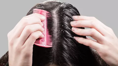 De ce apare mătreața și cum să o tratezi eficient? Care sunt ingredientele active care combat mătreața?