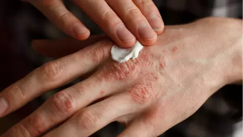 Alifia care îți vindecă rănile și arsurile rapid, fără să rămâi cu semne pe piele. Conține un antibiotic natural