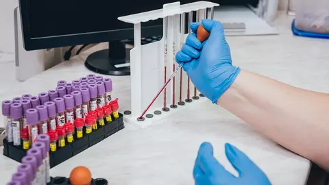 Care sunt analizele pe care trebuie să le faci pentru a depista cancerul pancreatic