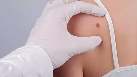 Cum arată MELANOMUL?