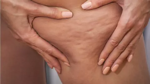 Cum scap de celulită într-o lună? Pașii simpli care te ajută să înlături aspectul de coajă de portocală