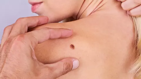 Cum știm că o aluniță se transformă în melanom? Schimbările care trebuie să ne trimită la medicul dermatolog