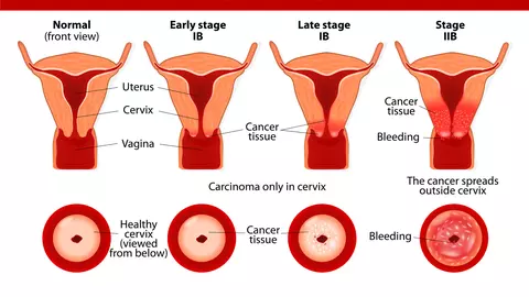 De ce apare cancerul de col uterin și cum se transmite virusul care îl declanșează? Dr. Elvira Brătilă a dat explicații uluitoare
