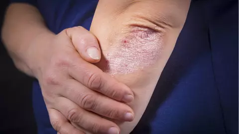 Ce este psoriazisul? Iată cele mai bune remedii naturiste pentru a controla simptomele acestei boli