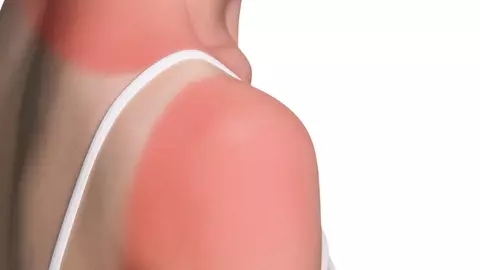 Cum poți trata rapid arsurile solare? 7 remedii care funcționează de fiecare dată