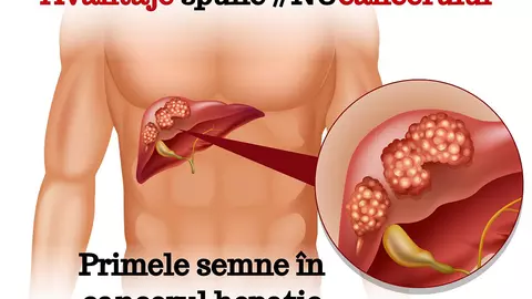 Primele semne în cancerul hepatic