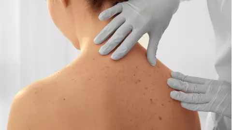 Cancer de piele. Cum arată și care sunt cele mai întâlnite tipuri?