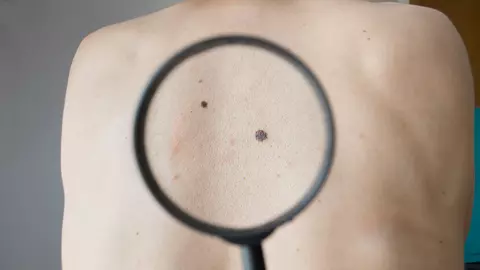 Care este diferența dintre carcinom și melanom? Care este mai agresiv?