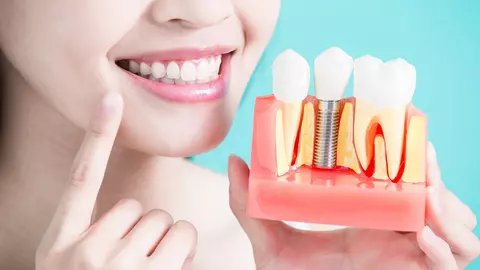 Ce ar trebui să alegem: implant dentar sau proteză dentară?