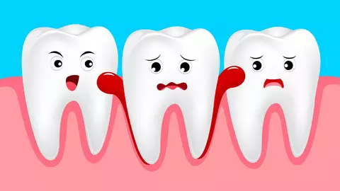 De ce sângerează gingiile. Cele mai frecvente 6 cauze ale acestei probleme