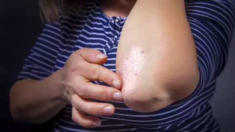 Psoriazisul nu este contagios! Peste 2% din populaţia României suferă de psoriazis