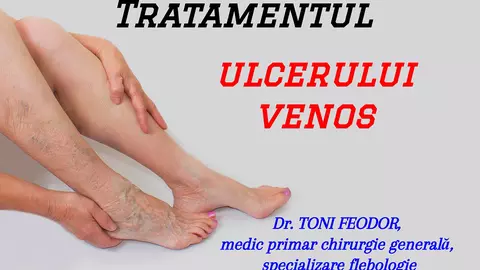 Ce este ulcerul venos și care este cel mai adecvat tratament. VIDEO