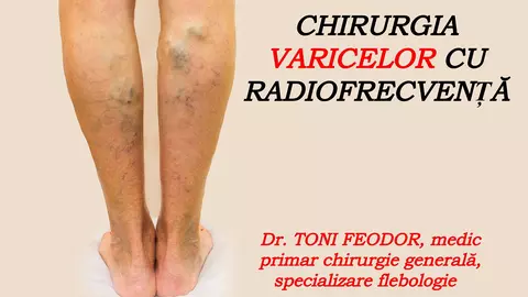 Dr. Toni Feodor, medic primar chirurgie generală, specializare flebologie: cum decurge o operație de varice. VIDEO