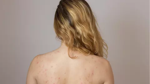 Acneea pe spate și piept – de ce apare și cum poate fi prevenită