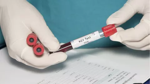 Al doilea pacient din lume vindecat de HIV. Ce tratament a funcționat în cazul bărbatului?