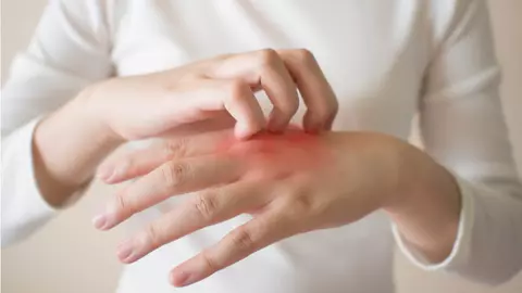 Cum poți trata rapid eczemele? 4 lucruri de care trebuie să ții cont