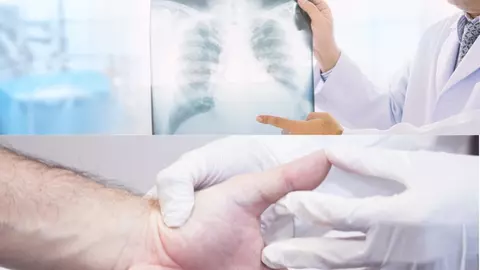 Semnele apărute la nivelul mâinilor care pot anunța cancerul pulmonar. Schimbările pe care trebuie să le iei în calcul