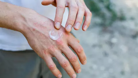 Aproximativ 5% dintre români suferă de psoriazis. Boala NU este transmisibilă