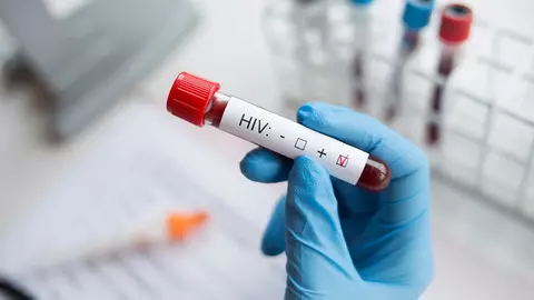 Un bărbat din Londra a devenit a doua persoană din lume vindecată de HIV