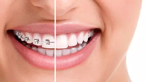 (P) Iată cele mai folosite tipuri de aparat dentar și beneficiile acestora!  