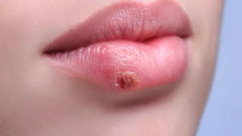 (P) Herpes bucal - cum să scapi rapid de el cu tratamentele moderne!