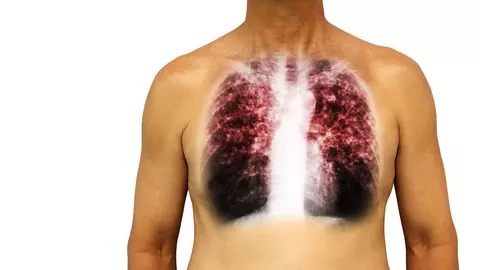 Descoperire senzațională a medicilor spanioli: în cât timp se instalează pneumonia după infectare