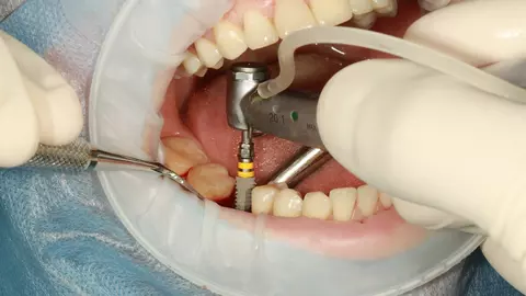 (P) Cele mai bune tipuri de implanturi dentare