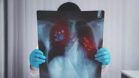 În atenția celor care au avut COVID: CT-ul pulmonar este esențial în evaluarea procesului de vindecare