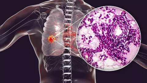 Cancerul pulmonar pe înțelesul tuturor