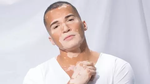 Vitiligo l-a făcut mai special: un model brazilian nu-și mai ascunde imperfecțiunile pielii