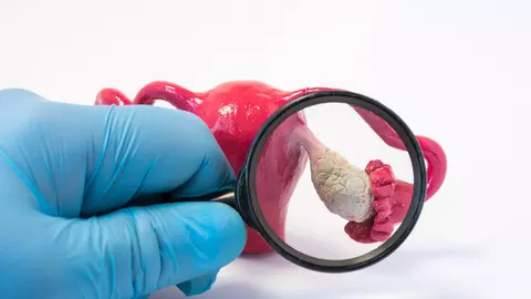 Atenție, cancerul ovarian se confundă des cu alte afecțiuni având simptome identice