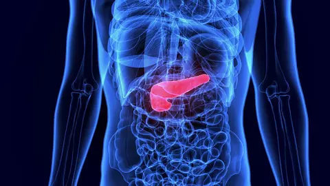 De ce e descoperit târziu cancerul pancreatic