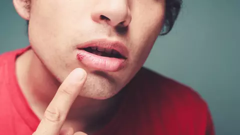 Herpesul bucal. Cum să scapi de herpes bucal cât mai repede posibil?
