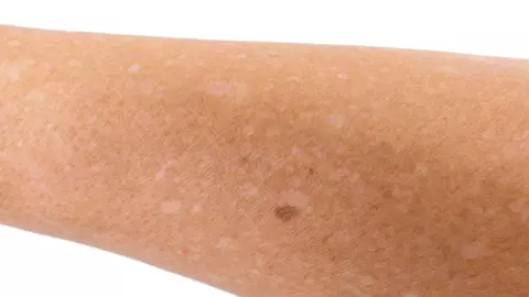 De ce am pete albe pe mâini?