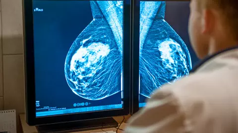 Aspirina, potențial tratament inovator pentru cancerul de sân agresiv