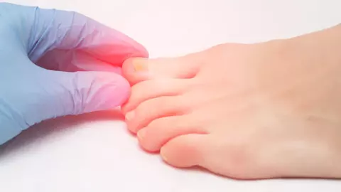 Ciuperca unghiilor de la picioare. Simptome, cauze și prevenție