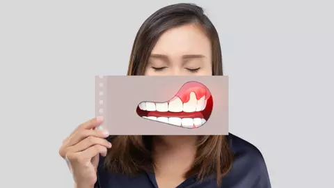 Cum scapi de sângerările gingivale?