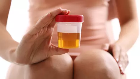 Ce spune culoarea urinei despre starea ta de sănătate?