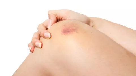 De ce te învinețești atât de repede? Ce spun vânătăile despre pielea ta?