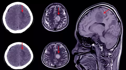 Cum se face recuperarea după un accident vascular cerebral? Abordare integrată, cu viziune regenerativă
